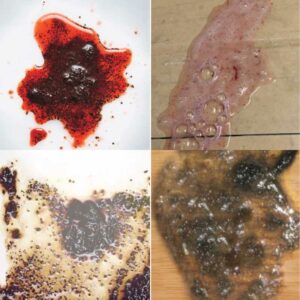 coffee ground emesis pictures